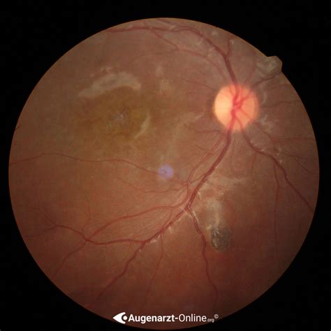 Morbus Stargardt Fundus Flavimaculatus Atlas Der Augenheilkunde