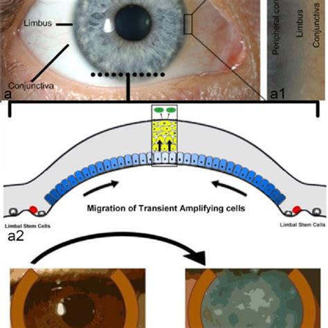 PDF Autologous Corneal Repair Using In Vitro Adult Stem Cell Expansion