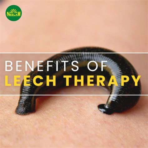 Leech Therapy In Delhi Leech Therapy In Delhi By Neelam Dawakhana