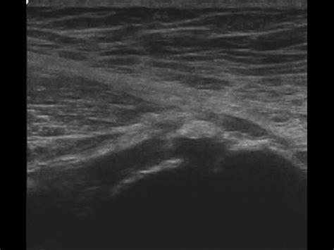 Gluteus Medius Tear Ultrasound