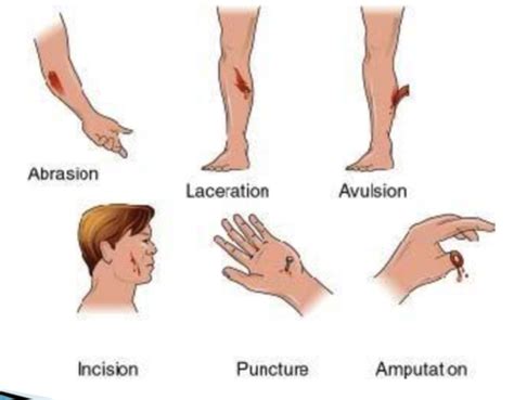 Wounds Dressings Flashcards Quizlet