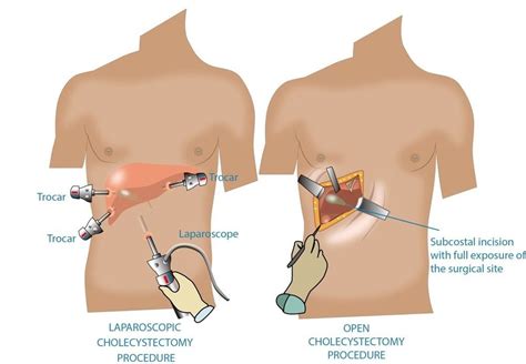 Gallbladder Removal Modern Laparoscopic Surgery