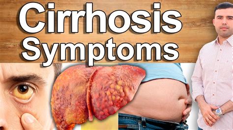 Your Liver Is Damaged 8 Symptoms Of A Damaged Liver Or Cirrhosis You Should Never Ignore Youtube