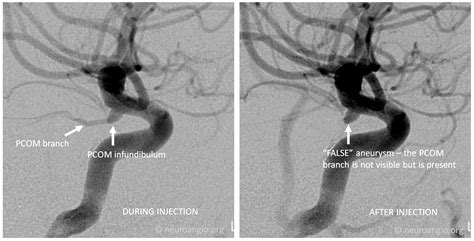 Infundibulum | neuroangio.org