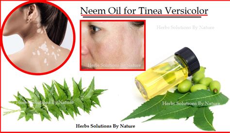 Neem Oil for Tinea Versicolor Natural Remedies and Natural Essential Oils - Herbs Solutions By ...