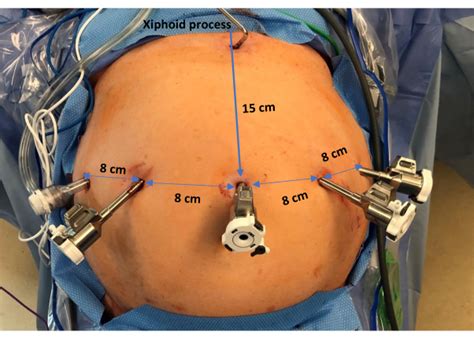 Robotic Heller Myotomy For Advancements In Surgical Management Of