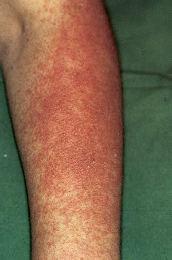 Acute Irritant Contact Dermatitis With Erythema Papules And Scaling