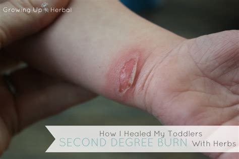 How I Healed My Toddlers Second Degree Burn With Herbs In Less Than 5