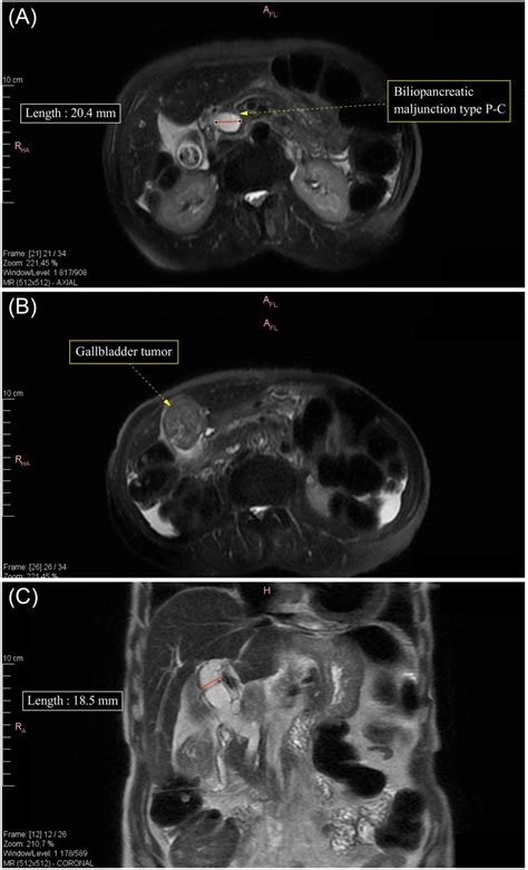 Adenosquamous Carcinoma Of Gallbladder Associated With Biliopancreatic Maljunction And Todani 1c