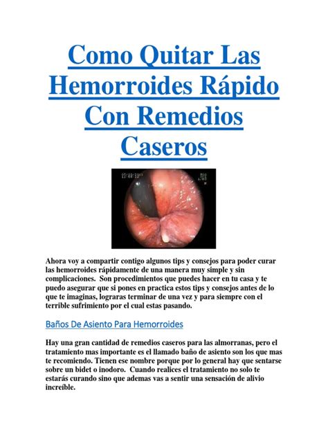 Como Quitar Las Hemorroides Rápido Con Remedios Caseros Hemorroides