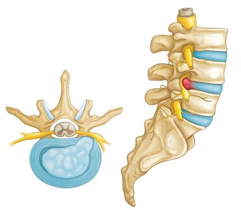 Hernia De Disco En La Zona Lumbar