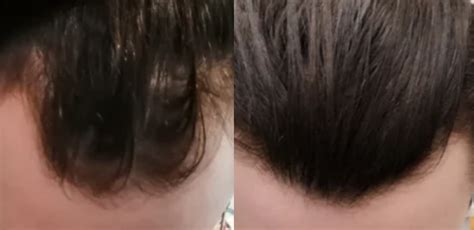 Finasteride And Minoxidil For 11 Months Photo Wrassman M D Baldingblog