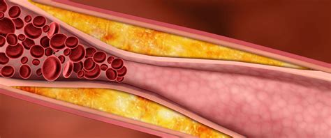 Dislipidemias Salud Lts