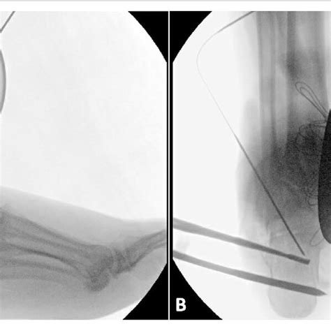 Fluoroscopic Views A Lateral View B Axial View Of A Left Foot