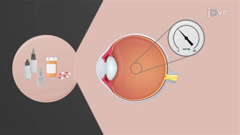 Angle Closure Glaucoma: Treatment | Pharmacology | JoVe