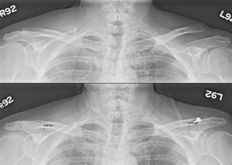 A Preoperative Upright Bilateral Standing Anteroposterior AP