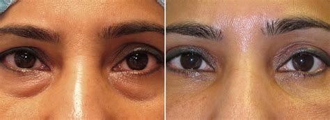 Upper Blepharoplasty Lower Blepharoplasty Dark Circles Treatment