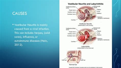 Vestibular Neuritis