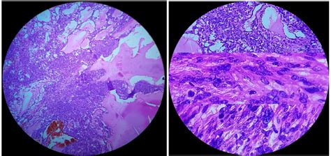 Histopathological Section Showing A Tumor Composed Of Interlacing