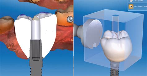 Vita Implant Solutions The Implant Prosthetic Restoration Concept