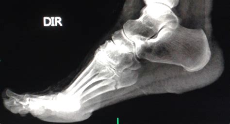 Dicas De Radiologia Tudo Sobre Radiologia Imagens RadiolÓgicas Fratura Quinto Metatarso