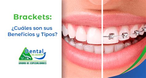 Brackets Cuáles son sus Beneficios y Tipos Clinica Dental del Country