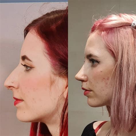 Rhinoplasty Before After Got My Cast Off Today R PlasticSurgery