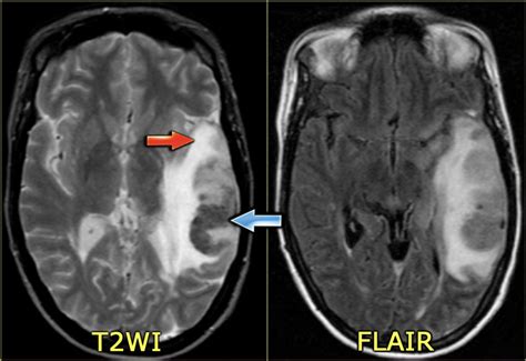 The Radiology Assistant Cerebral Venous Thrombosis