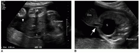 Abdominal Wall Disorders Radiology Key