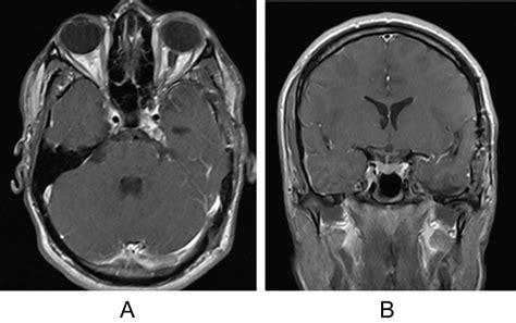 Cavernous Sinus Mri