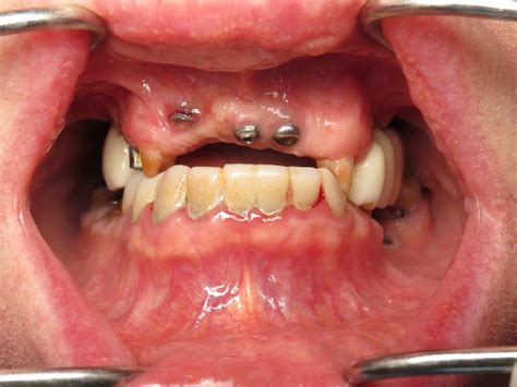 Gum Graft Transplant For Dental Implants Is It Necessary