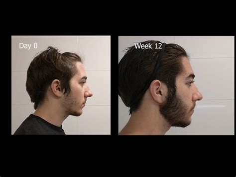 Minoxidil Beard Journey Years Later How To Grow A Real 43 Off