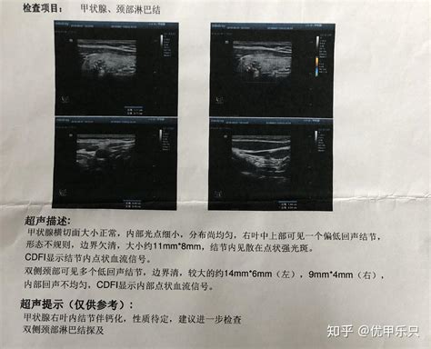 202019更新~甲状腺癌手术全过程及术后恢复持续更新 知乎