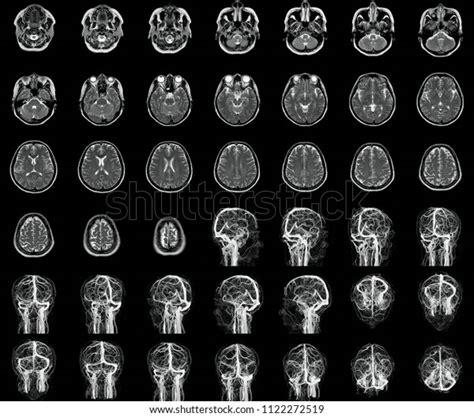 Mri Mra Brain Collection Xray Film Stock Photo Shutterstock