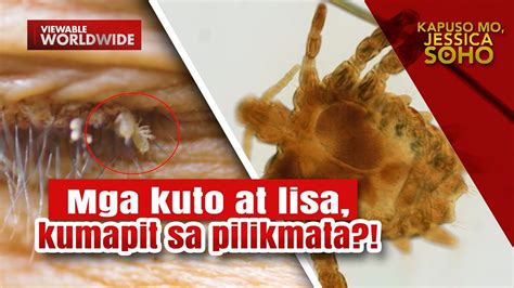 Mga Pilikmata Ng Isang Pamilya Pinamamahayan Ng Mga Kuto At Lisa Kapuso