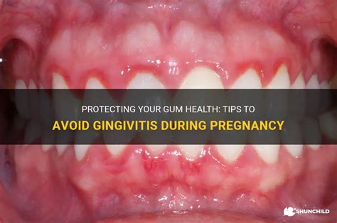 Protecting Your Gum Health Tips To Avoid Gingivitis During Pregnancy