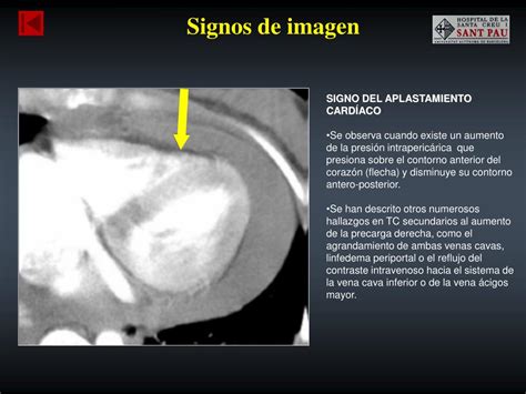 PPT Taponamiento cardíaco Causas y hallazgos radiológicos PowerPoint