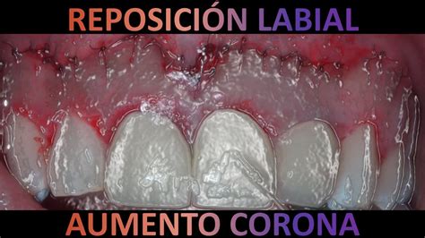 Reposición labial gingivectomía y gingivoplastía cirugiaperiodontal