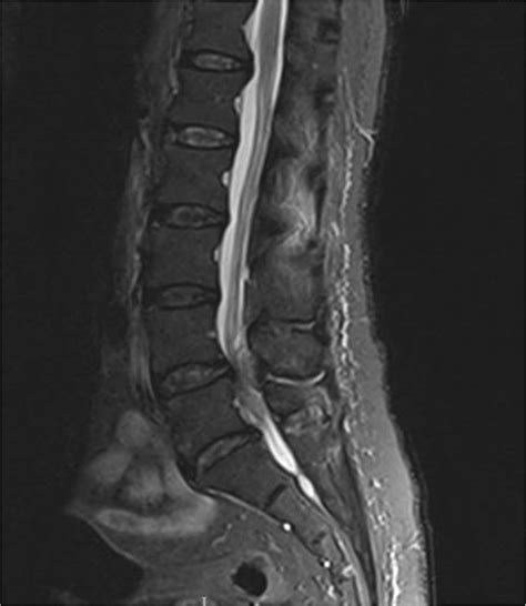 File:MRI of the lumbar spine with abscess in the posterior epidural space, causing cauda equina ...