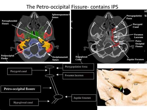 Inferior petrosal sinus 360°