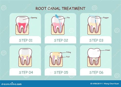 Cartoon Tooth Root Canal Treatment Stock Vector Image 69863819