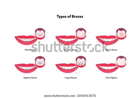 257 Types Teeth Braces Images, Stock Photos & Vectors | Shutterstock