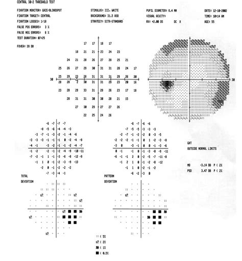 Visual Fields American Academy Of Ophthalmology