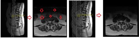 Mri Saturation Band Artifacts