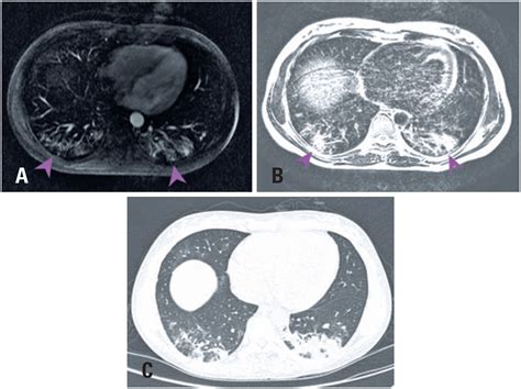 Scielo Brasil Covid 19 On Resonance Magnetic An Incidental But