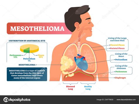 Mesothelioma Vector Illustration Labeled Lung Cancer Educational