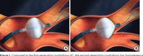 Pdf Cryoballoon Ablation For Atrial Fibrillation A Comprehensive Review And Practice Guide