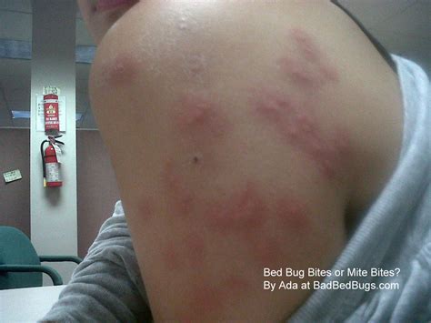 carpet mites bites    byron wells blog