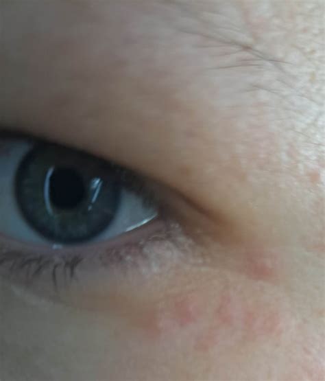 Red Spot Under Eye R Skincareaddicts