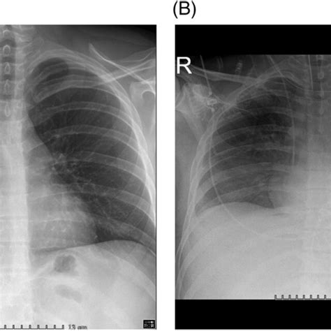 Ambulatory Chest Radiograph Panel A And Following Transfer To The